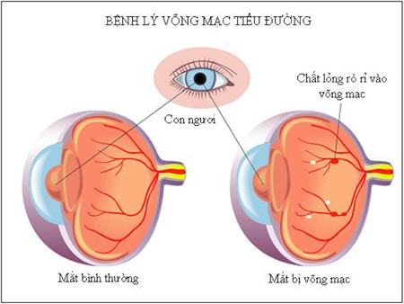Võng mạc tiểu đường - Hình ảnh minh họa